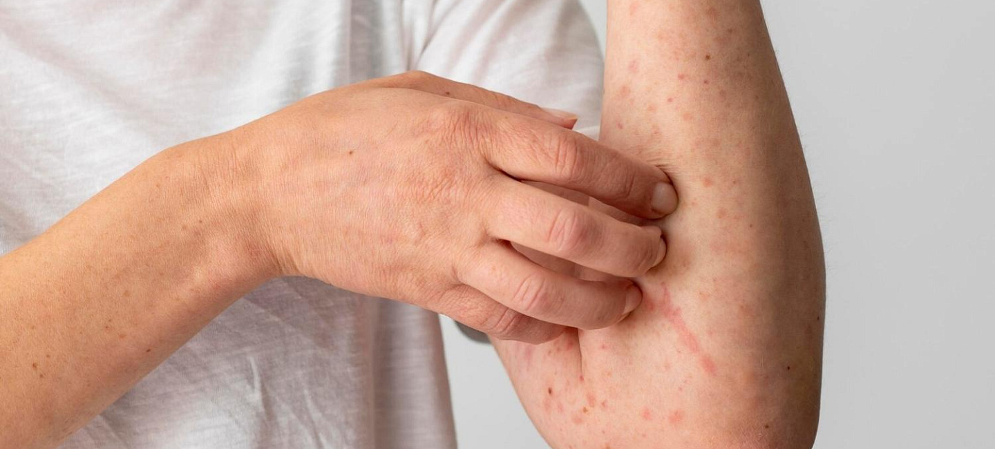 Симптомы и лечение аллергической крапивницы